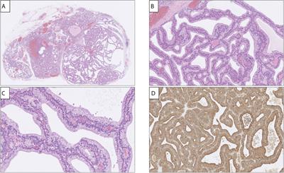 Parathyroid Adenoma With Respiratory-Like Epithelium: Case Report of a Potential Mimic With Unknown Etiology